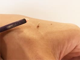 もぐさを使用した直接灸